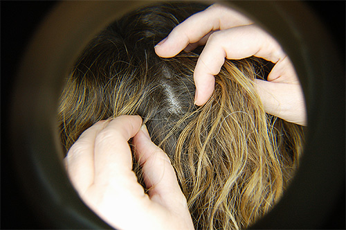 يمكن أن تساعد فحوصات الشعر المنتظمة في الكشف عن الإصابة بقمل الرأس في وقت مبكر.