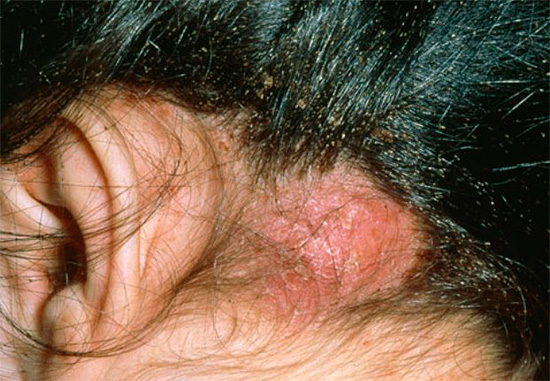 Vid ett stort antal löss kan sårskorpor uppstå i hårbotten.